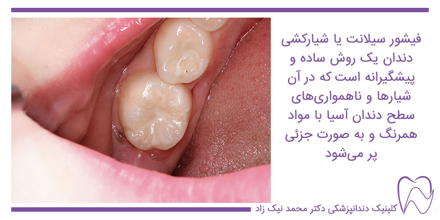فیشور سیلانت یا شیارکشی دندان آسیا