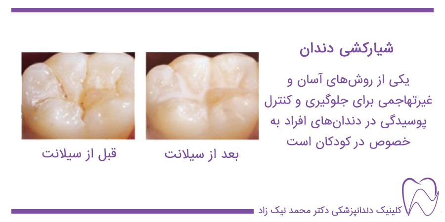 عکس قبل و بعد از شیار کشی دندان