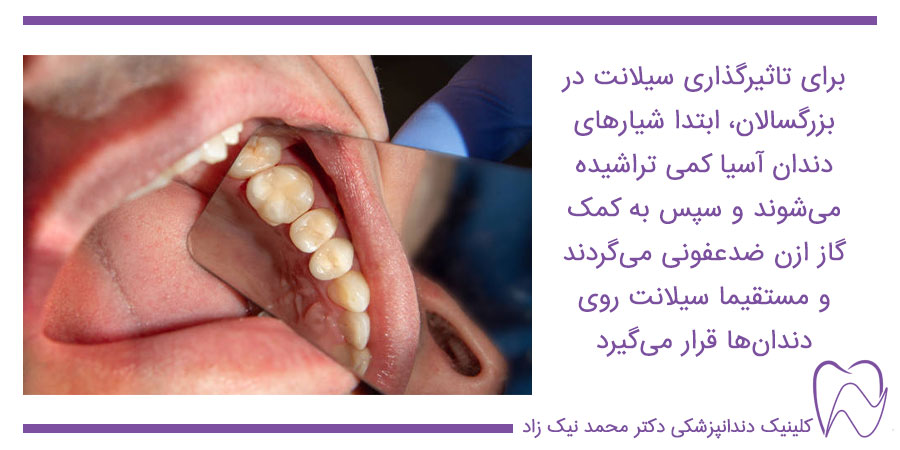 فیشورسیلانت دندان در بزرگسالان