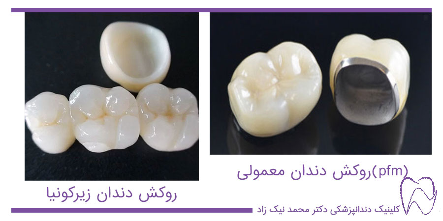 تفاوت روکش دندان زیرکونیا با روکش های معمولی