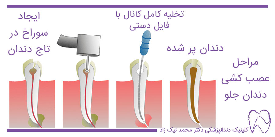 مراحل عصب کشی دندان جلو