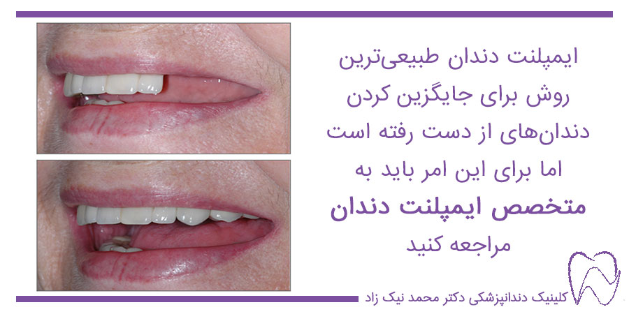 عکس قبل و بعد از ایمپلنت دندان