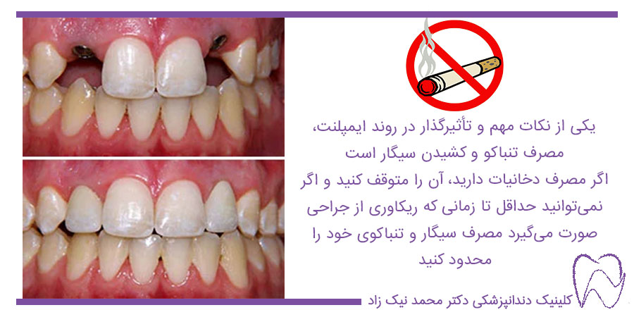 ایمپلنت دندان جلو برای افراد سیگاری