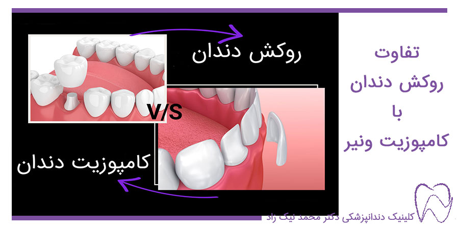 تفاوت روکش دندان با کامپوزیت