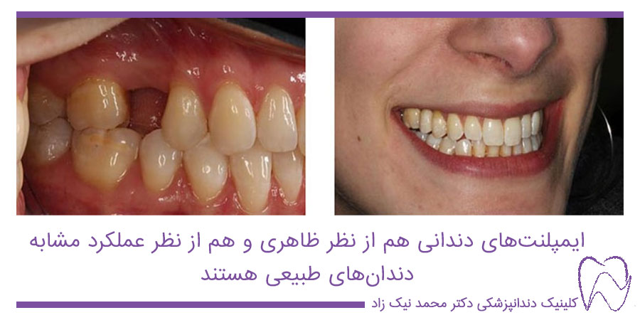تفاوت ایمپلنت با دندان طبیعی
