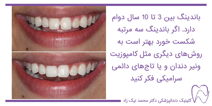 طول عمر باندینگ دندان