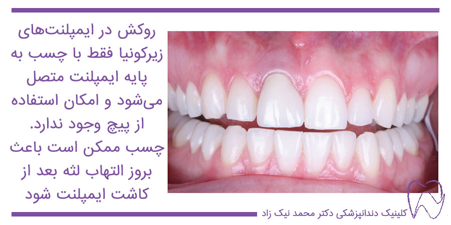 التهاب لثه بعد از ایمپلنت دندان