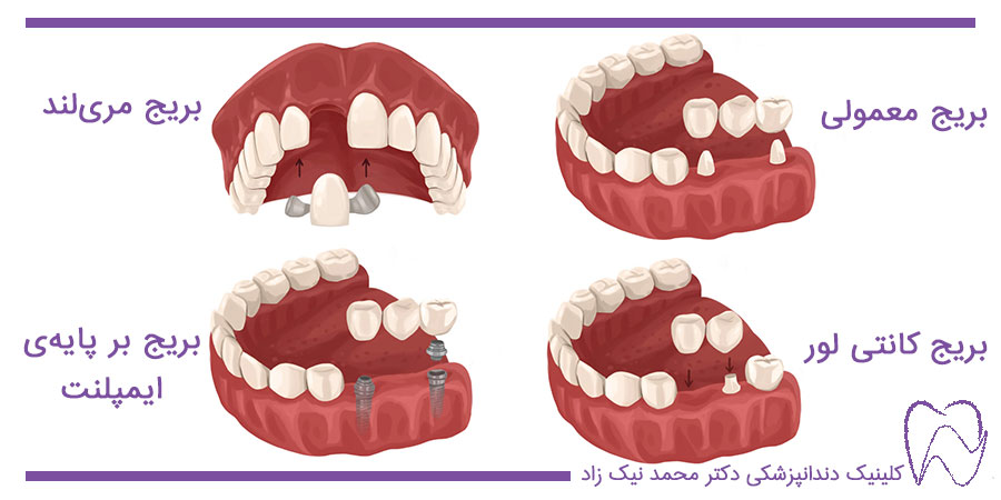 انواع بریج یا پل دندانی