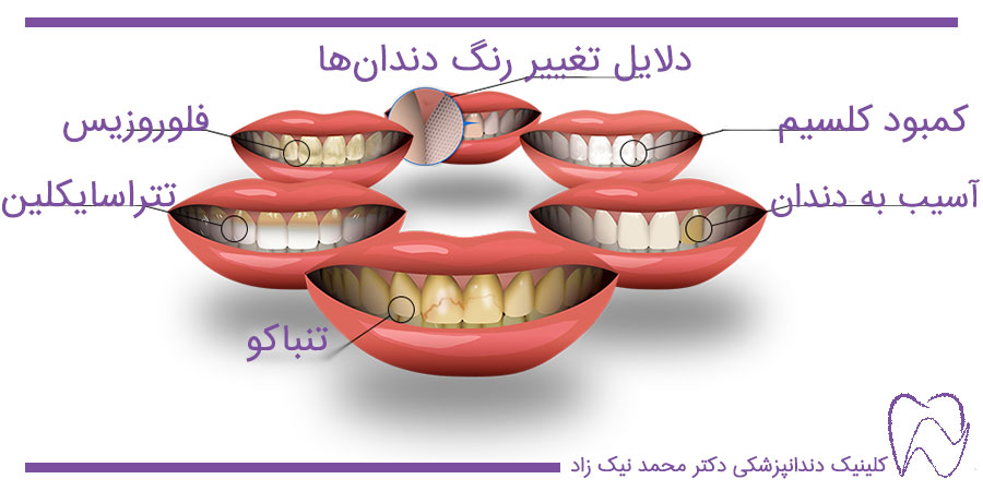 علت‌های تغییر رنگ دندان