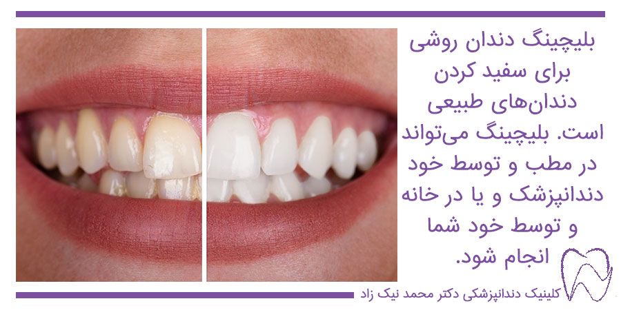 بلیچینگ دندان