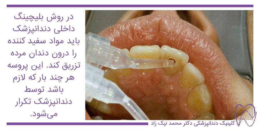 بلیچینگ داخلی دندان