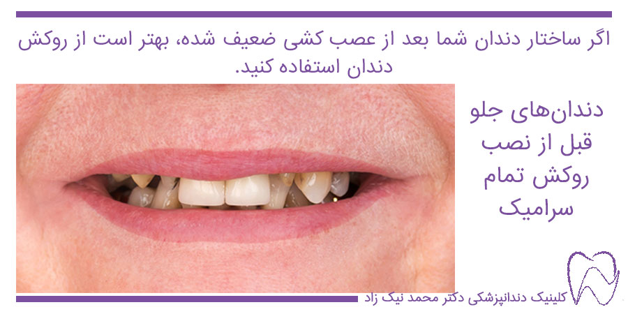 عصب کشی دندان جلو و تراش دندان قبل از روکش