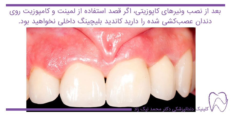 کامپوزیت دندان جلو بعد از عصب کشی