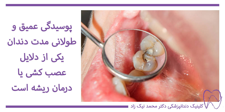 دلایل عصب‌ کشی دندان