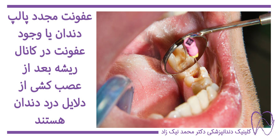 عصب کشی مجدد دندان