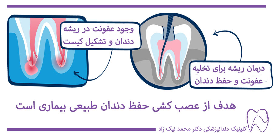 درمان ریشه دندان عفونی