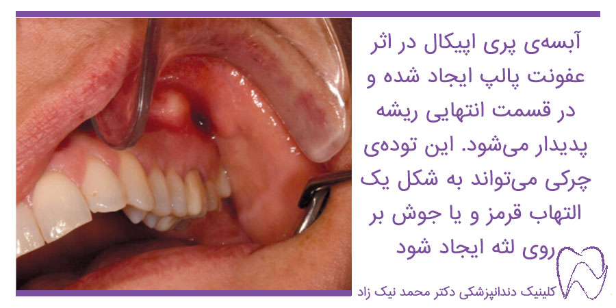 علائم عفونت ریشه دندان