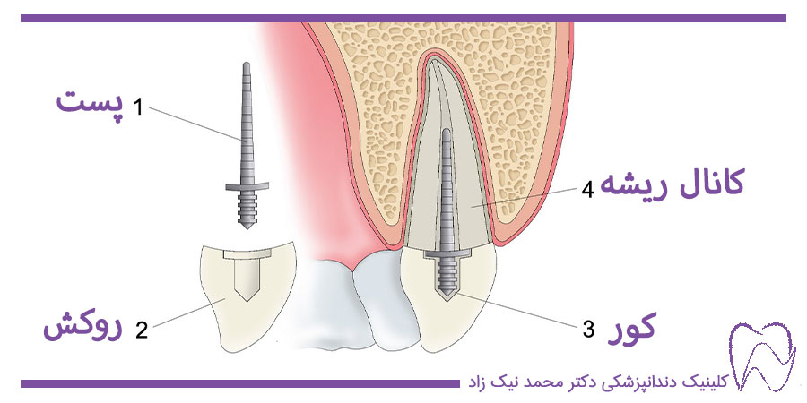 مراحل پست و کور دندان
