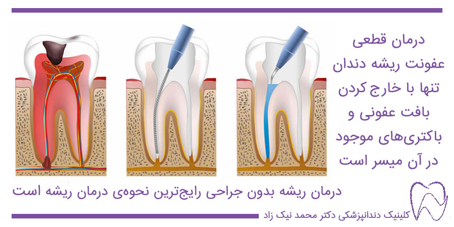 درمان قطعی عفونت ریشه دندان