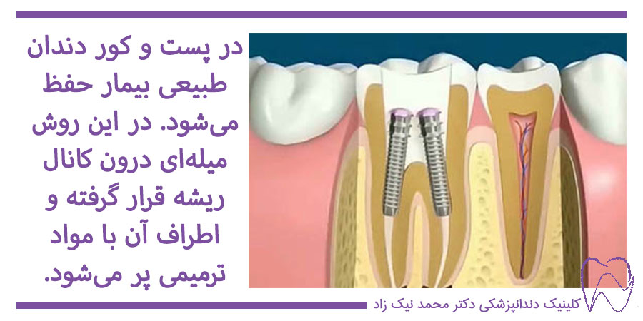 روش پست و کر برای دندان عقب