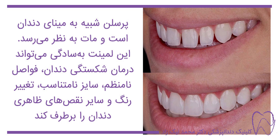 قبل و بعد از لمینت سرامیکی دندان
