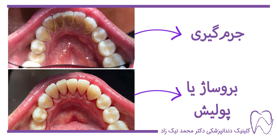 عکس قبل و بعد از پولیش دندان
