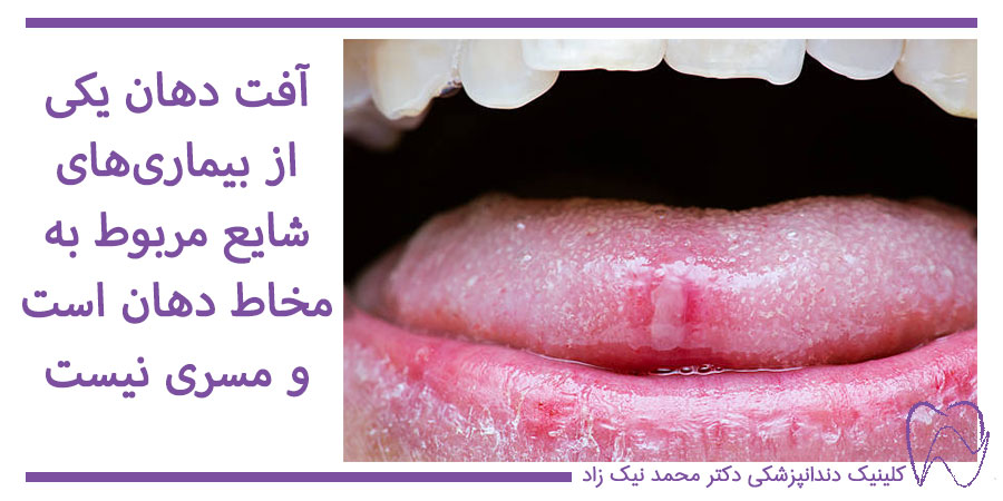 آفت دهان در بزرگسالان و روی زبان