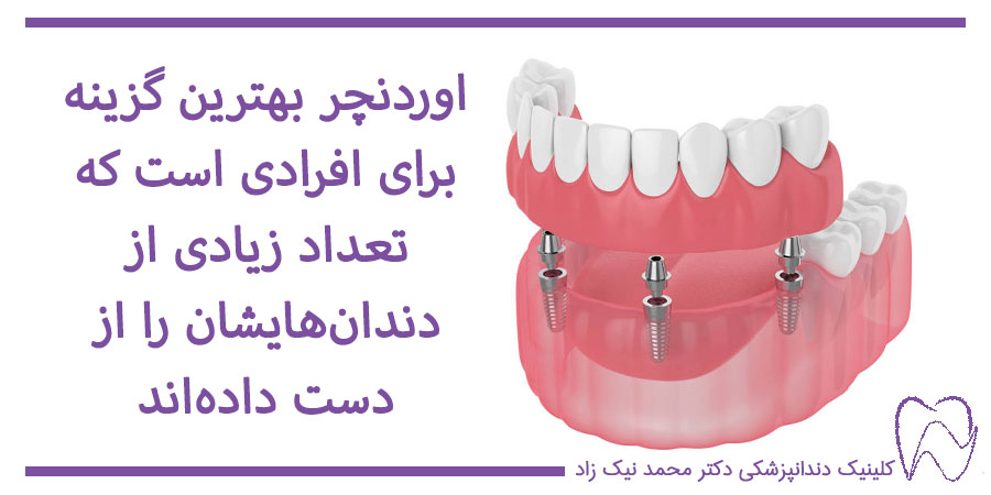 اوردنچر بر پایه ایمپلنت دندانهای جلو