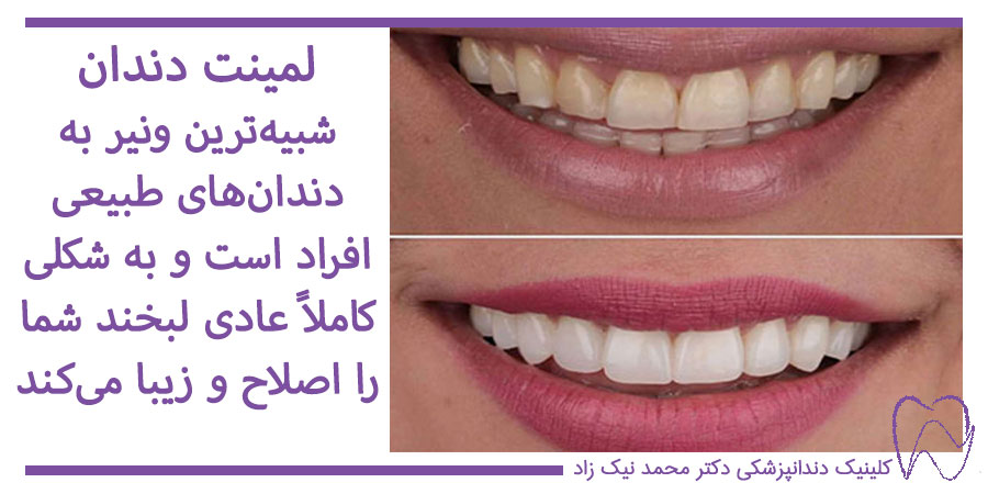 عکس قبل و بعد از لمینت دندان
