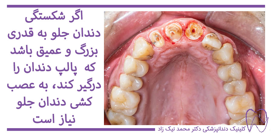 درمان شکستگی عمیق دندان جلو از ریشه