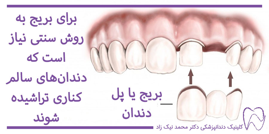 بریج یا پل دندان چیست