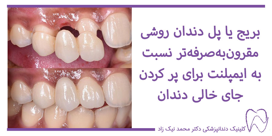 عکس قبل و بعد از بریج دندان