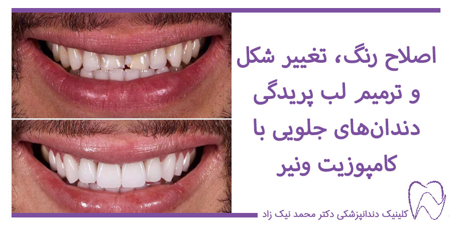 قبل و بعد از کامپوزیت دندان‌های جلویی بالا
