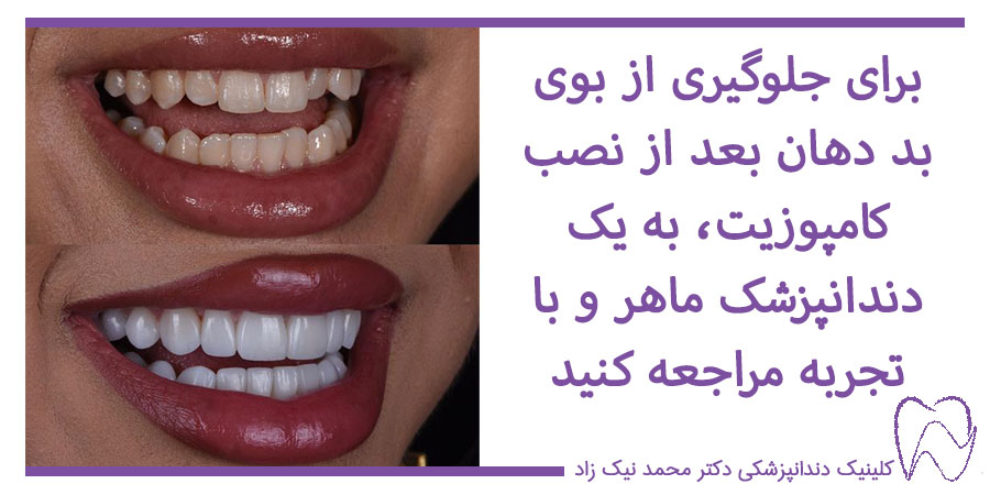 عکس قبل و بعد از کامپوزیت دندانها