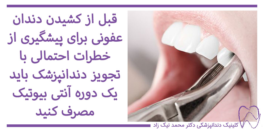 کشیدن دندان عفونی