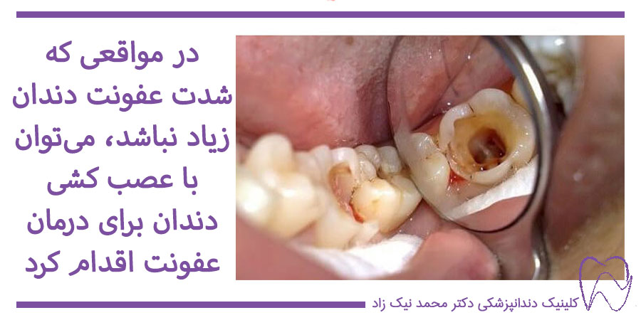 عصب کشی دندان عفونی