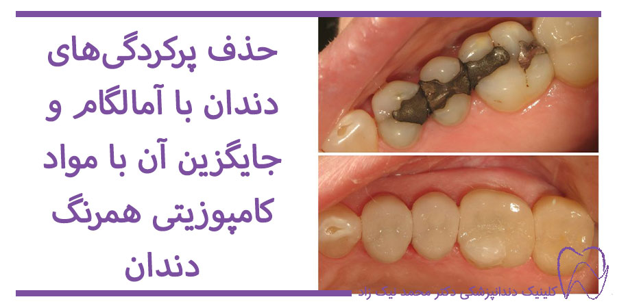 تفاوت امالگام با کامپوزیت دندان