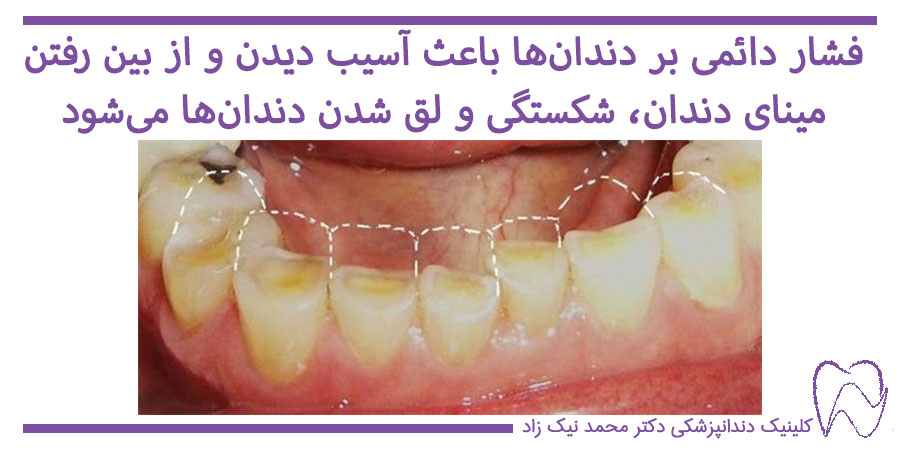 عوارض دندان قروچه
